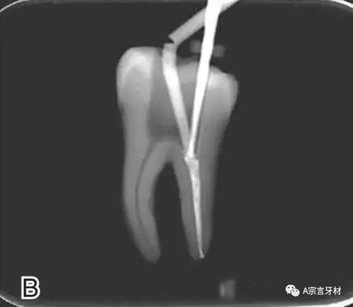 视频详解 连续波热牙胶充填技术的经典操作步骤